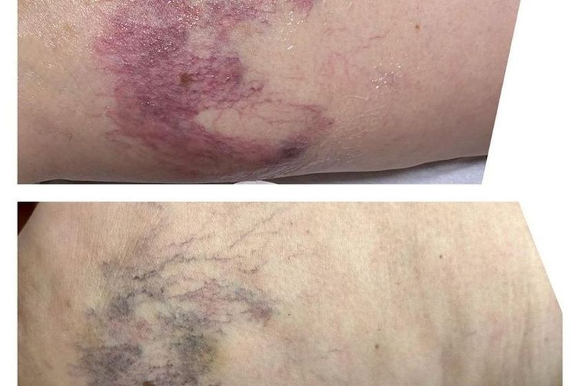 Tratamiento varices antes y después - 819084