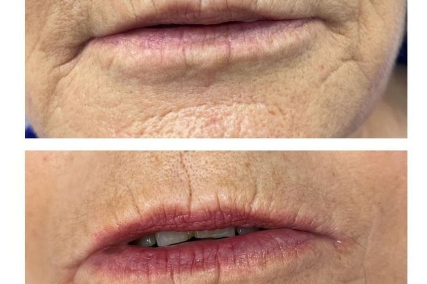 Microneedling antes y después - 839442