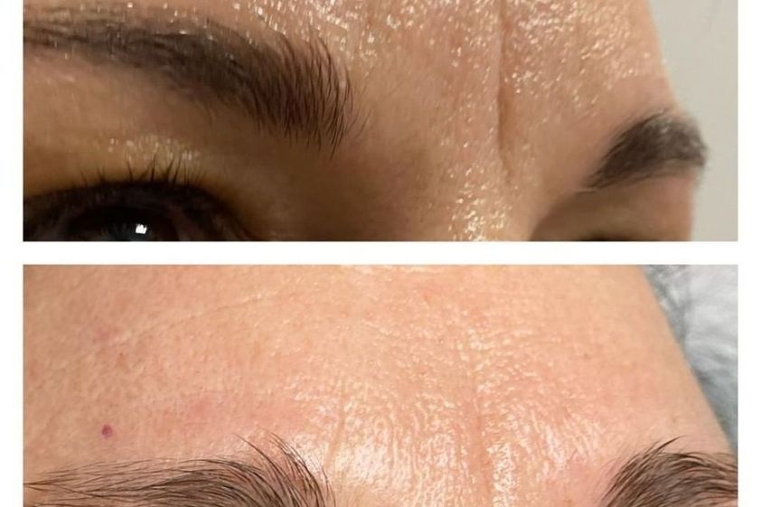 Radiofrecuencia facial antes y después - 839443