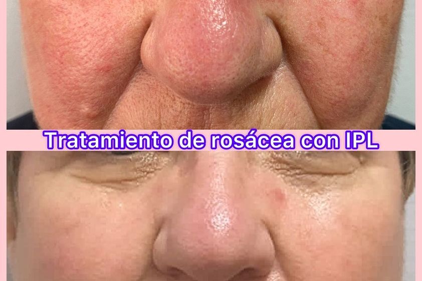 Rosácea antes y después - 839448