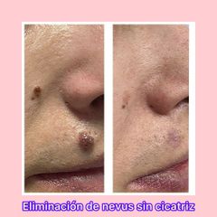 Verrugas - Clínica Suárez