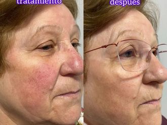 Rosácea antes y después - 860482