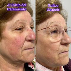 Rosácea - Clínica Suárez