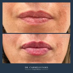 Aumento de labios - Dfine Clinic