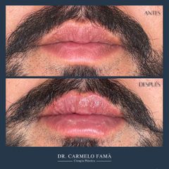Aumento de labios - Dfine Clinic