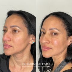 Rellenos faciales - Dfine Clinic