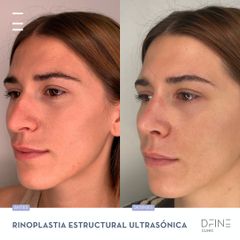 Rinoplastia - Dfine Clinic