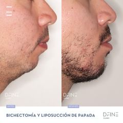 Bichectomia - Dfine Clinic