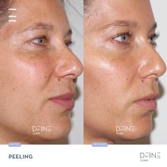 Peeling - Dfine Clinic