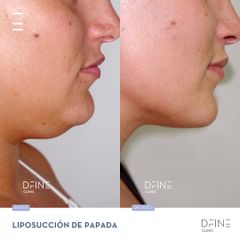 Liposucción - Dfine Clinic