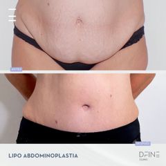 Abdominoplastia - Dfine Clinic