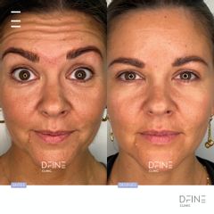 Rellenos faciales - Dfine Clinic
