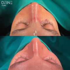 Rinoplastia - Dfine Clinic