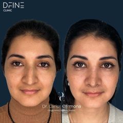 Rinoplastia - Dfine Clinic