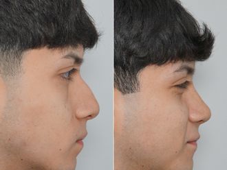 Rinoplastia antes y después - 878469