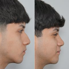 Rinoplastia Masculina