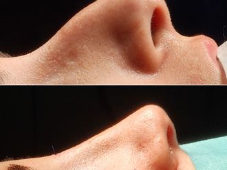 Rinoplastia antes y después - 878470