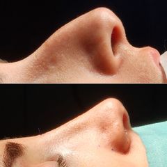 Rinoplastia femenina