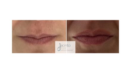 Antes y después  Aumento labios con ácido hialurónico