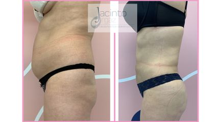 Antes y después  Lipo e injerto graso - Doctor Jacinto Orgaz Molina
