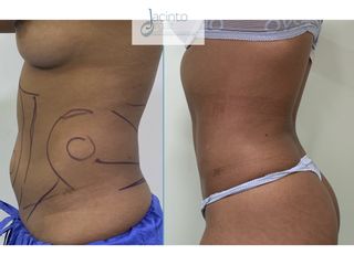 Antes y después  Liposucción - Doctor Jacinto Orgaz Molina