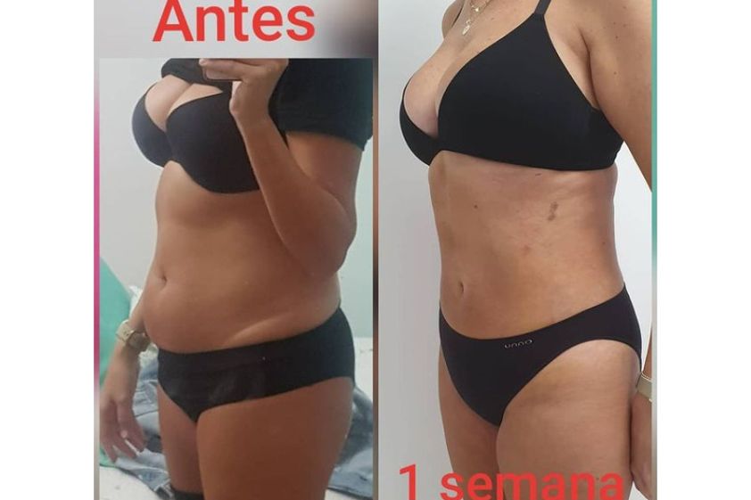 Liposucción antes y después - 800414