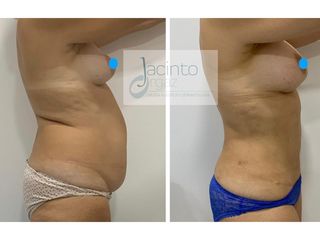 Liposucción - Doctor Jacinto Orgaz Molina