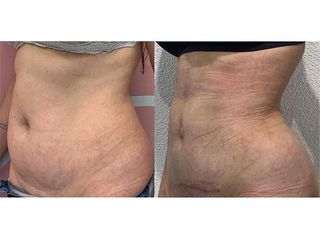 Abdominoplastia - Doctor Jacinto Orgaz Molina