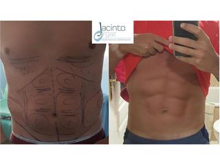 Marcación Abdominal - Doctor Jacinto Orgaz Molina
