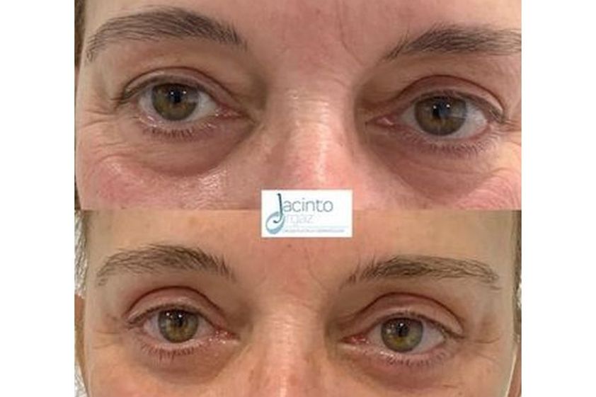 Eliminación ojeras antes y después - 812133