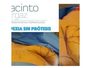 mastopexia - Doctor Jacinto Orgaz Molina