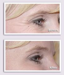 Antes y después botox