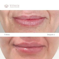 Aumento de labios - Clínica Villoria