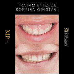 Sonrisa Gingival