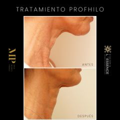 Tratamiento Profhilo