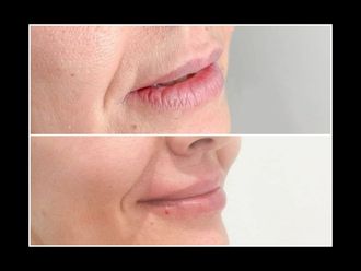 Aumento labios antes y después - 872498