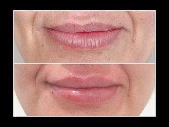 Aumento labios antes y después - 872499