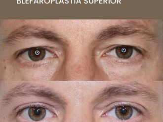 Blefaroplastia antes y después - 872500