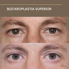 Blefaroplastia Láser Superior