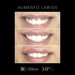 Aumento de Labios