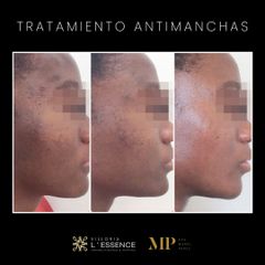 Tratamiento Antimanchas