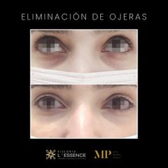 Eliminación de Ojeras