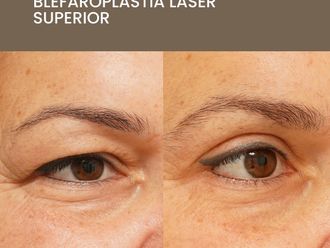 Blefaroplastia antes y después - 872568