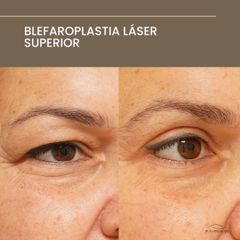 Blefaroplastia Láser Superior