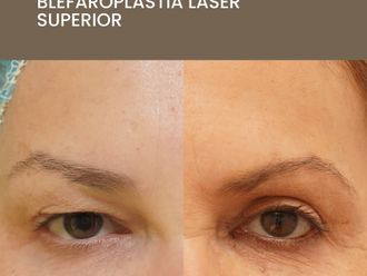 Blefaroplastia antes y después - 872569