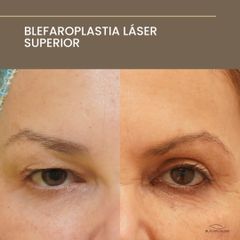 Blefaroplastia Láser Superior