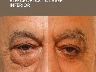 Blefaroplastia antes y después - 872570