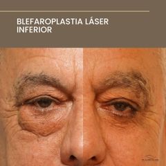 Blefaroplastia Láser Inferior