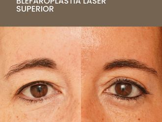 Blefaroplastia antes y después - 872571