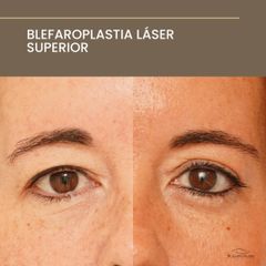 Blefaroplastia Láser Superior